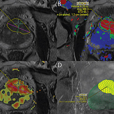 Prostate Cancer Diagnosis Improves with MRI Technology