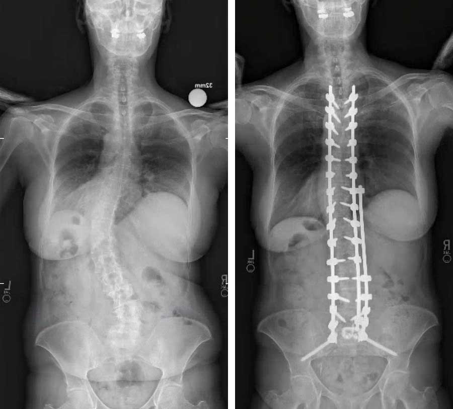 Before and after X-rays of spine