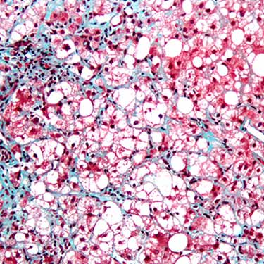 Fatty Liver Disease and Scarring Have Strong Genetic Component