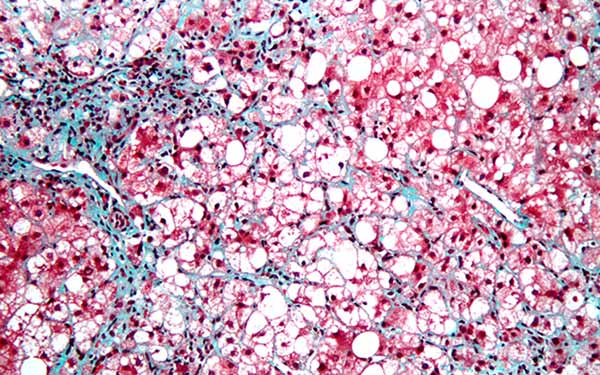 Image: A micrograph of an inflamed fatty liver