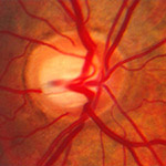 Identified Genetic Interaction Offers Possible New Target for Glaucoma Therapy