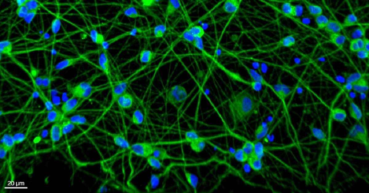 $13 Million CIRM Award to Fund Research on the Role of RNA Pollution in Neurodegenerative Diseases