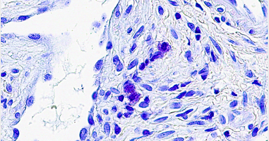 Airborne Toxins Trigger a Unique Form of Chronic Sinus Disease in Veterans