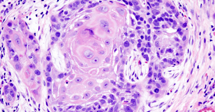 Graphic of squamous cell carcinoma of the mouth