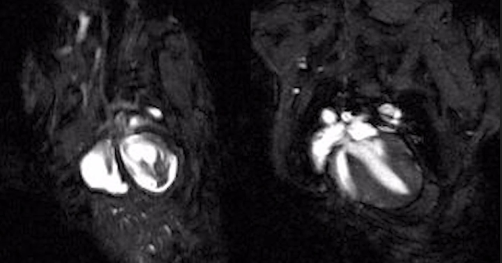 Could Gene Therapy Treat a Deadly Heart Condition That Targets Young Athletes?