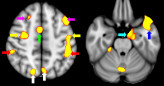 A comparison of two functional brain images